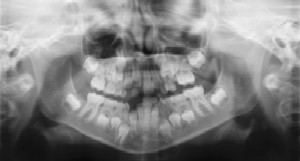 Dental Radiographs (X-Rays) - Pediatric Dentist in Boynton Beach, FL