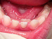 Baby Teeth - Pediatric Dentist in Boynton Beach, FL